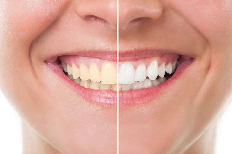 Teeth Whitening in Costa Mesa